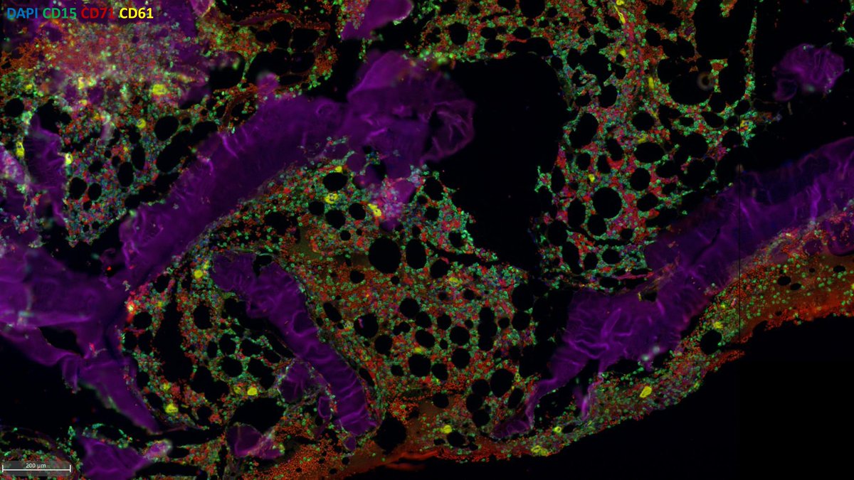 #MultiplexIF image of a normal human decalcified bone marrow biopsy tissue, *entire core* captured with the 
@AkoyaBio
 Vectra Polaris in the #MISILab 
@WCMCPathology
 #multipleximaging #multiIF #pathart #hemepath #hematopathology #pathology