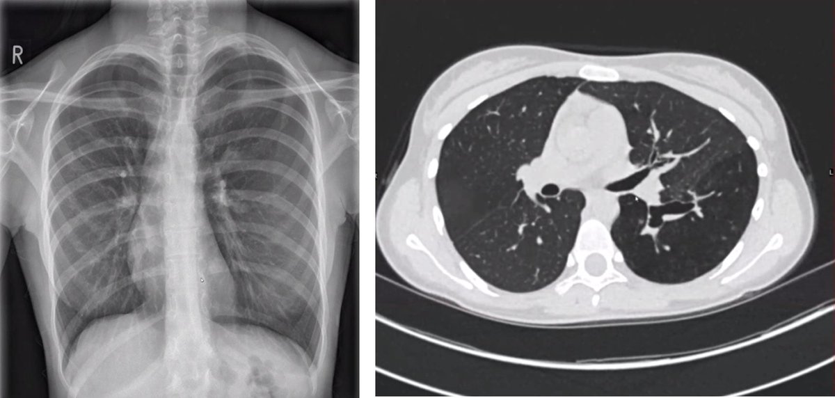 Radiology case of the week - Bronchial atresia: focal obliteration of the proximal segment of LLL bronchus &amp;  hyperinflation of the distal lung presenting as SOB &amp; recurrent infection. Consider foreign body as differential diagnosis; surgical resection may be indicated.