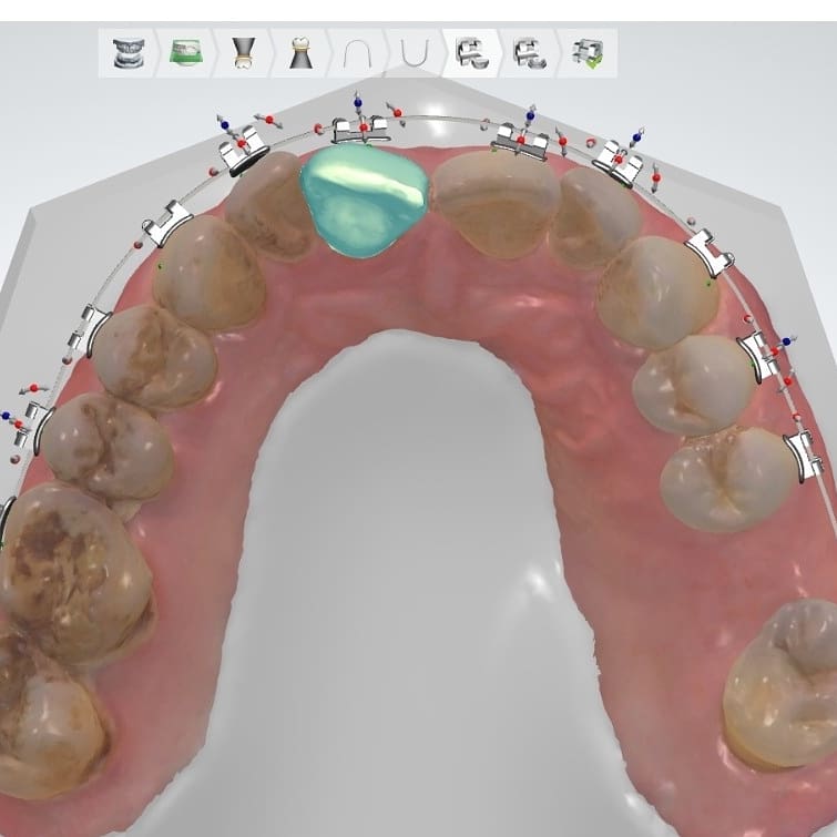Sürekli öğrenmeye devam ediyoruz🤓 çok kıymetli Prof.Dr. Serdar Üşümez hocamız ile yaptığımız DİBS ve ameliyat splinti  bizim içinde çok fazla yeniliği barındıran bir çalışma oldu 😎#ortodonti #ortodontist #digitalindirectbonding  #digitalortodonti #dijitalortodontiuzmanı #3shape