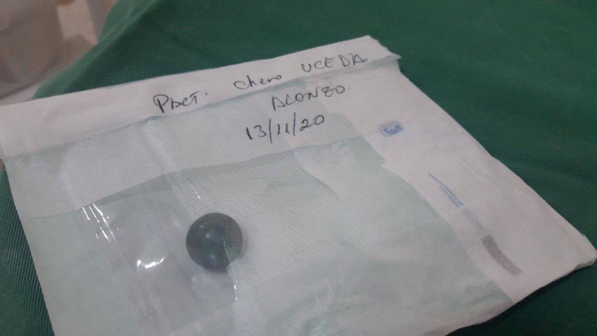 mal_menor's tweet photo. Esta es la bola tipo canica que la PNP disparó directamente a la espalda a Alonso Chero, fotógrafo de El Comercio, cuando hacia su trabajo ayer. Fue extraída del interior de su cuerpo. Ocurrió casi a la misma hora en que el ministro del interior decía que solo usan lacrimógenas https://t.co/2nOt72W0n6