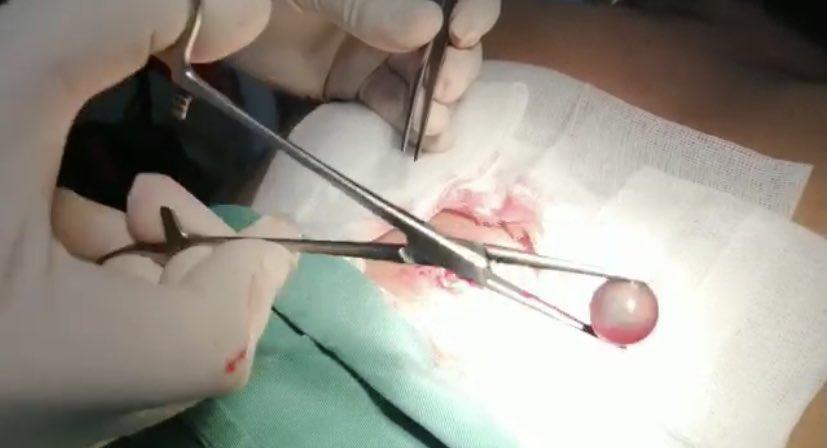 mal_menor's tweet photo. Esta es la bola tipo canica que la PNP disparó directamente a la espalda a Alonso Chero, fotógrafo de El Comercio, cuando hacia su trabajo ayer. Fue extraída del interior de su cuerpo. Ocurrió casi a la misma hora en que el ministro del interior decía que solo usan lacrimógenas https://t.co/2nOt72W0n6