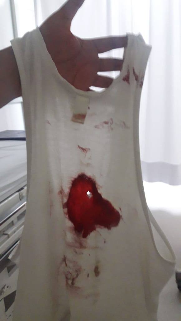 mal_menor's tweet photo. Esta es la bola tipo canica que la PNP disparó directamente a la espalda a Alonso Chero, fotógrafo de El Comercio, cuando hacia su trabajo ayer. Fue extraída del interior de su cuerpo. Ocurrió casi a la misma hora en que el ministro del interior decía que solo usan lacrimógenas https://t.co/2nOt72W0n6