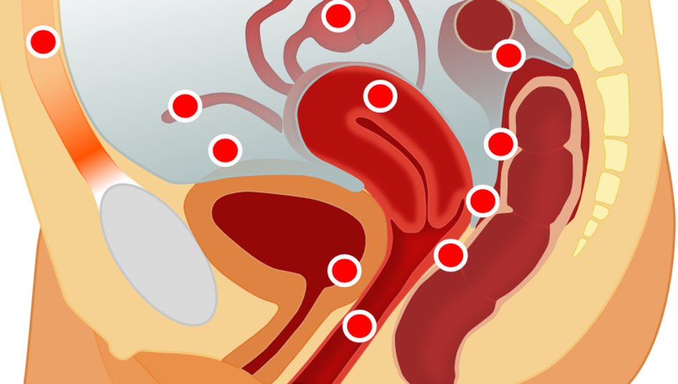 inamedof's tweet photo. #Endometriosis y #fertilidad?

Entre el 10 y el 20% de las mujeres en edad fértil padecen endometriosis cuyos síntomas son:

• #Menstruación dolorosa.
• #Dolor pélvico no menstrual
• Dolor con las relaciones sexuales.
• Esterilidad.
• Cansancio.
#concitacientifica https://t.co/kcW8oaM6ry