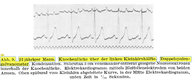 Here's some cerebellar EEG. Did NOT know that was already in there  @IowaParkerLab 10/N