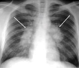 JikekaCOMM3724's tweet photo. TB positive chest x-ray 
A chest x-ray can show damage in your lungs and this is how doctors can see whether or not you have TB https://t.co/cmI4GfCRpA