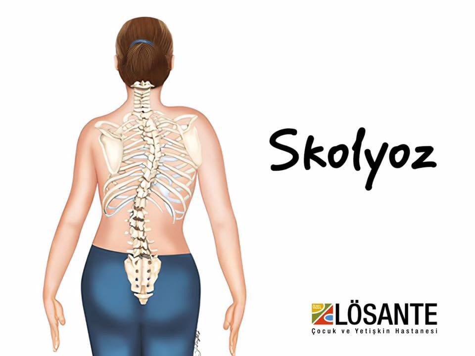 Omurga eğriliği ( SKOLYOZ ) olan ancak maddi imkanı iyi olmayan hastaların da 
LÖSANTE HASTANEMİZE müracaat etmelerini rica ederiz .
Her şey para değildir .