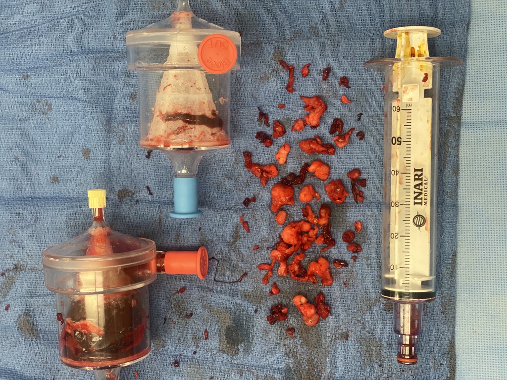Combined angiovac and ClotTriever to remove chronic caval thrombus and IVC filter. More options now available for these difficult cases. <a href="/uclaVIR/">UCLA IR</a>