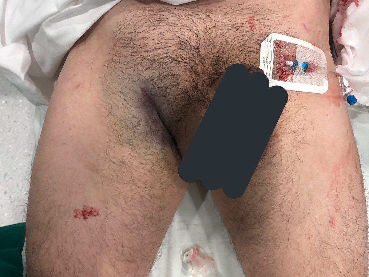 traumasotero's tweet photo. 30 min. GSW to the buttock. No pulses R/leg. Stable➡️AngioCT➡️vascular Injury 3 cm ⬆️ inguinal Lig. Better approach? and in an unstable patient?  #SoMe4Surgery  @pferrada1 @topknife @traumaicurounds @PipeCabreraV @kmattox1 @Cirbosque @traumadoctors @docmartin22 @traumakhan https://t.co/CGhOe9h8LV