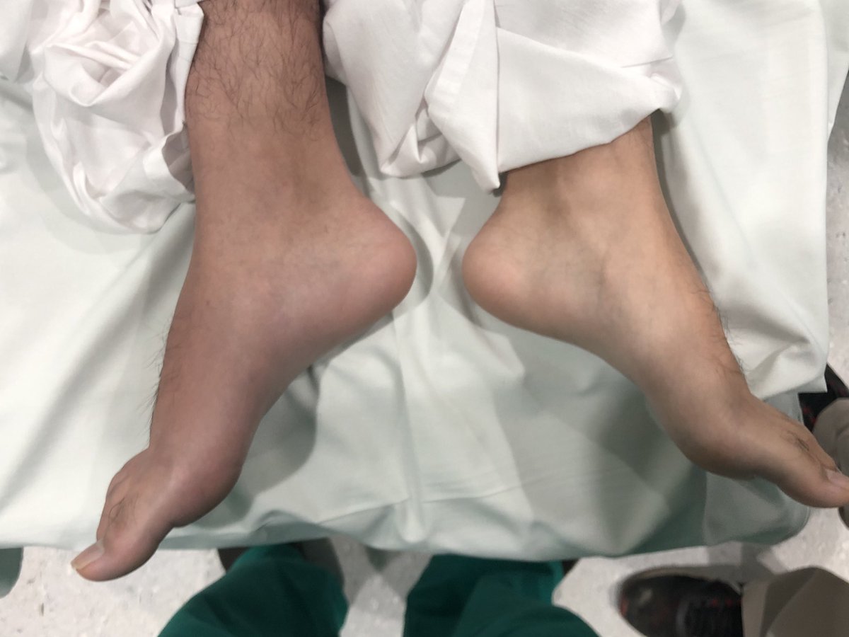 30 min. GSW to the buttock. No pulses R/leg. Stable➡️AngioCT➡️vascular Injury 3 cm ⬆️ inguinal Lig. Better approach? and in an unstable patient?  #SoMe4Surgery  <a href="/pferrada1/">Paula Ferrada MD FACS FCCM MAMSE</a> <a href="/TopKniFe_B/">Bellal Joseph</a> <a href="/traumaicurounds/">Dr. Dennis Yong Kim, MMEd</a> <a href="/PipeCabreraV/">Dr Luis Felipe Cabrera Vargas MD FACS</a> <a href="/kmattox1/">@Kmattox1</a> @Cirbosque <a href="/traumadoctors/">AAST</a> <a href="/docmartin22/">Matthew Martin, MD, FACS, McRIB</a> <a href="/traumakhan/">Mansoor Khan</a>