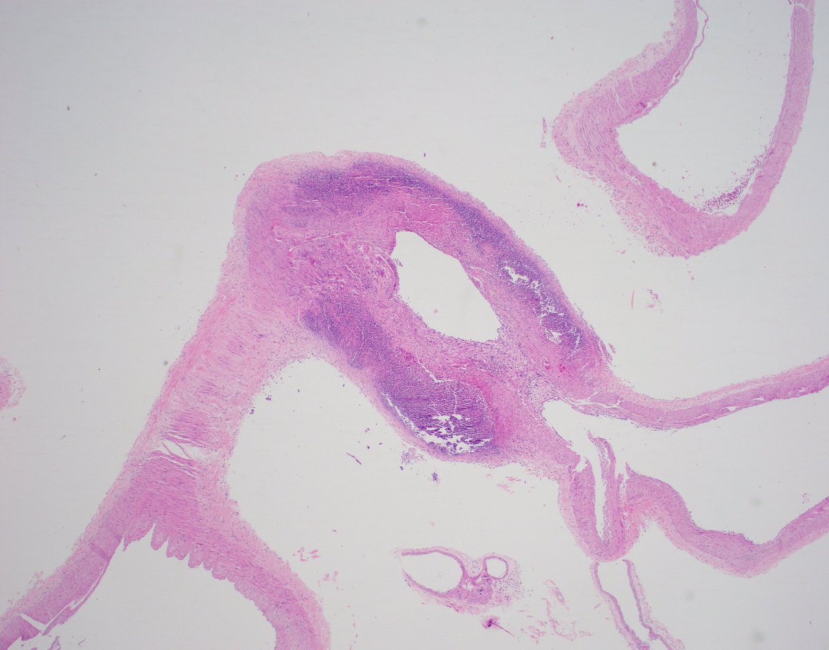 JLKresak's tweet photo. Impending mycotic aneurysm of posterior communicating artery. Mycotic is a misnomer since they are often caused by bacteria, as is the case here. Patient with pseudomonas. #neuropath #pathtwitter #pathology #histopath https://t.co/S3C0n6UQav