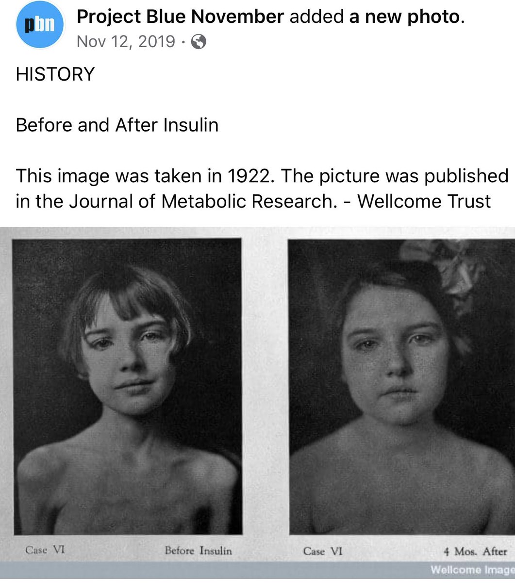 crettew's tweet image. Day 13 of diabetes awareness month- Quinn lost over 10 percent of her weight before being diagnosed.  She was 6. #typenone #type1 #type1diabetes #needacure