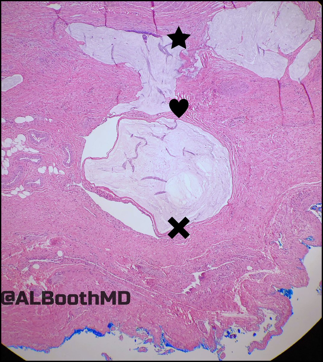 ALBoothMD's tweet photo. Lower anterior resection for rectal adenocarcinoma s/p neoadjuvant therapy. Where do you measure the margin from? Poll in reply #gipath https://t.co/Mw62EGYjVb