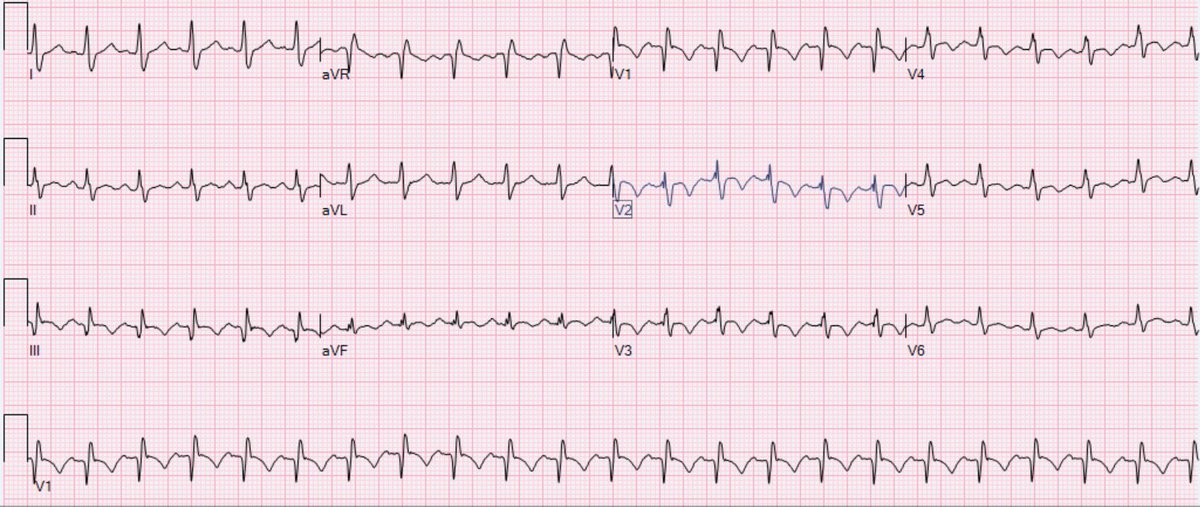 Young patient with shortness of breath, near syncope! What’s the “culprit”, how’d you interpret this deadly EKG?  #cardiotwitter