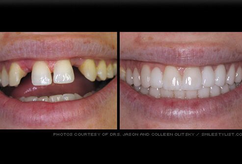 DentistryTfi's tweet photo. A DENTAL BRIDGE is essentially a #device anchored to surrounding #teeth that can replace one or more of the existing or #missingteeth. When a #losttooth is replaced with #cementedbridgework the teeth on either side of the missing one are prepared.
https://t.co/cq8HahTNqR https://t.co/1BE8LK8sKj
