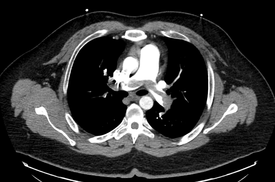 It’s important to recognize this deadly EKG because in right clinical context diagnosis can be made before CT angio. Sinus tachy, S1Q3T3, RBBB all new suggest RV strain. Massive saddle PE got tPA!