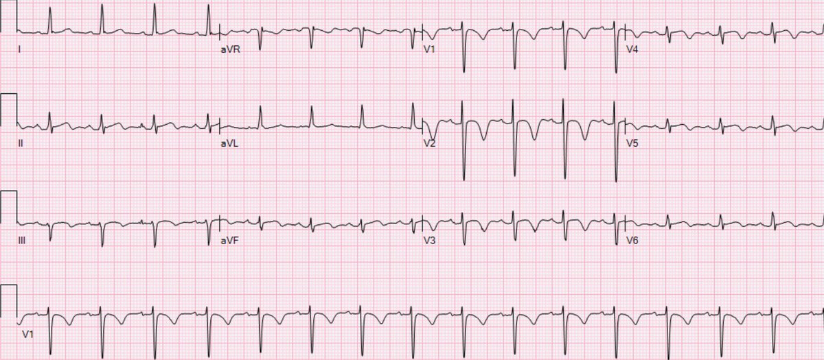 Went home however got re admitted with heart racing with activity. Repeat EKG, now what’s the culprit?  @yourheartdoc1  @doconmoney  @JdBapttiste  @DBelardoMD  @adityadoc1  @crisguedesb  @INC_CathLab  @doconmoney  @DrM3k  @EarlyAcc  @ekgpdx  @DrNasrien  @KoushikReddyMD  @Ricardo61234240