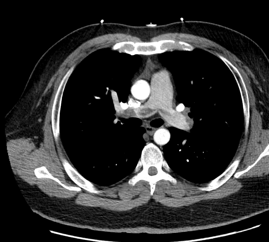 Repeat CTA (poor contrast bolus timing) persistent saddle PE ! Anyone has seen this? Despite tPA. persistent RVdilated reason for above EKG!  @Yalecards  @infeldMD  @turilrh  @jedicath  @mirvatalasnag  @jgloyo  @PowellJose  @karimratib  @KHERA_MD  @RealKushAgrawal  @shiskumar33  @samikhan0