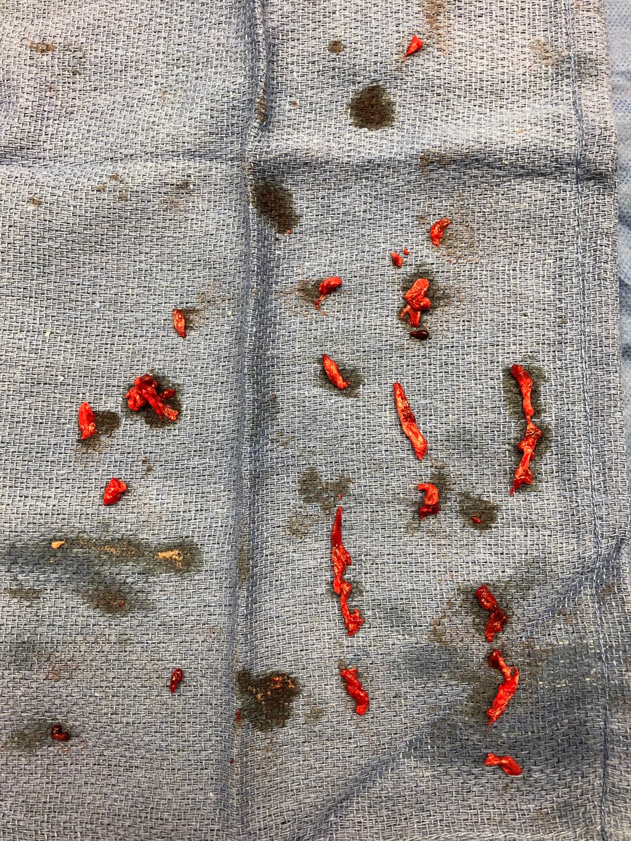 We went ahead and did CAT12  @PenVascular lightening embolectomy. It felt like tissue that’s why TPA failed! Patient did well!  @PLooserMD  @purviparwani  @cardioPCImom  @davidsafley  @mcbunte  @djc795  @dandu_n  @haseebqazi  @DrAsifQasim  @yaqoub_lina  @Uqayyum123  @DrToniyaSingh