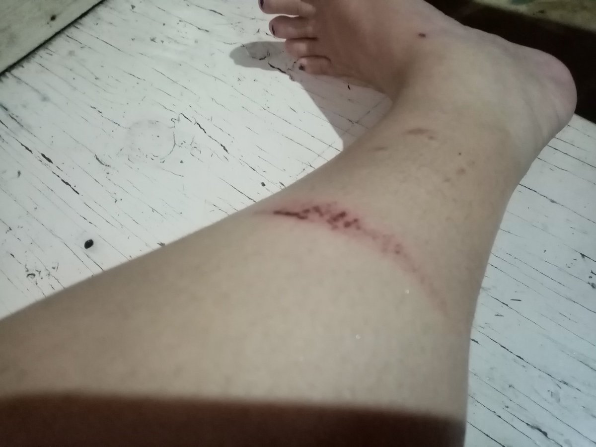 happypolkie15's tweet photo. Souvenir ni Ulysses. Pakikipag sagupa sa baha, both legs puro sugat. This is nothing compared sa mga naranasan ng mga kababayan natin.
#HELPCAGAYANNOW #HelpIsabela https://t.co/LY321cGcBC