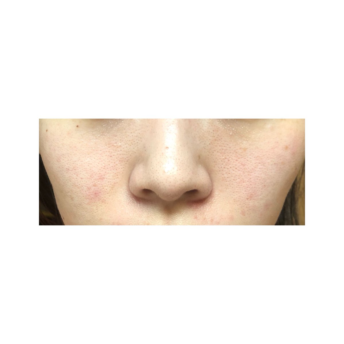 毛穴悩子 美容垢 ハリッチの次の日の肌 左 8月11日 11月13日 右 ハリがすごい 最近の悩みの目の下の鮫肌映ってますね これです これ でも8月のがぶつぶつ多い 本人的に 毛穴が縮んできたので他が気になってきたのでしょうか 昨日は散鍼で