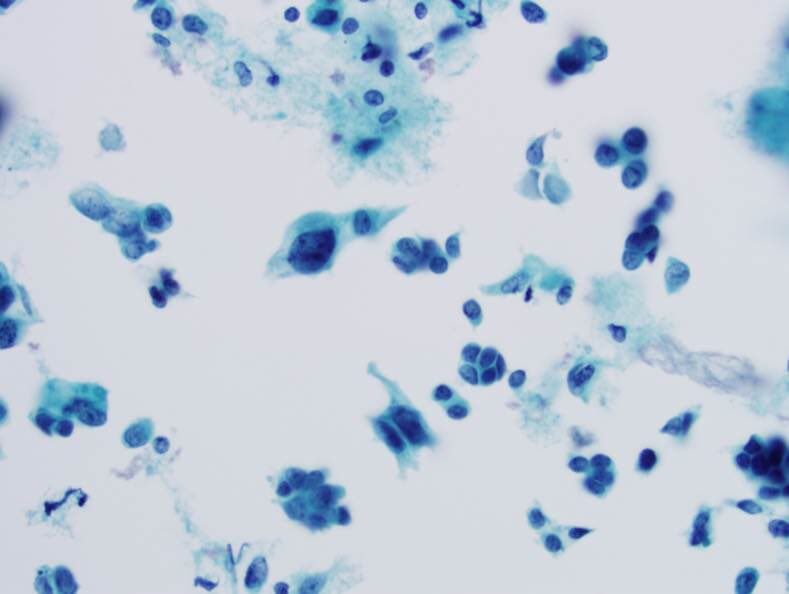 ZMaleki_cyto's tweet photo. Malignant Mixed Mullerian Tumor, Pap test , #SurePath, Cytopathology #89 #CytoPro @barkanga @PathPro @PVielh @doc_kartik @ALBoothMD @cytosantos @britishcytology @IACytology @elena_vigliar @mdlozanoe @tlabiano @PatMcIntireMD @MauroSaieg @tlabiano @NayarRitu https://t.co/7Xkh1jXpJt