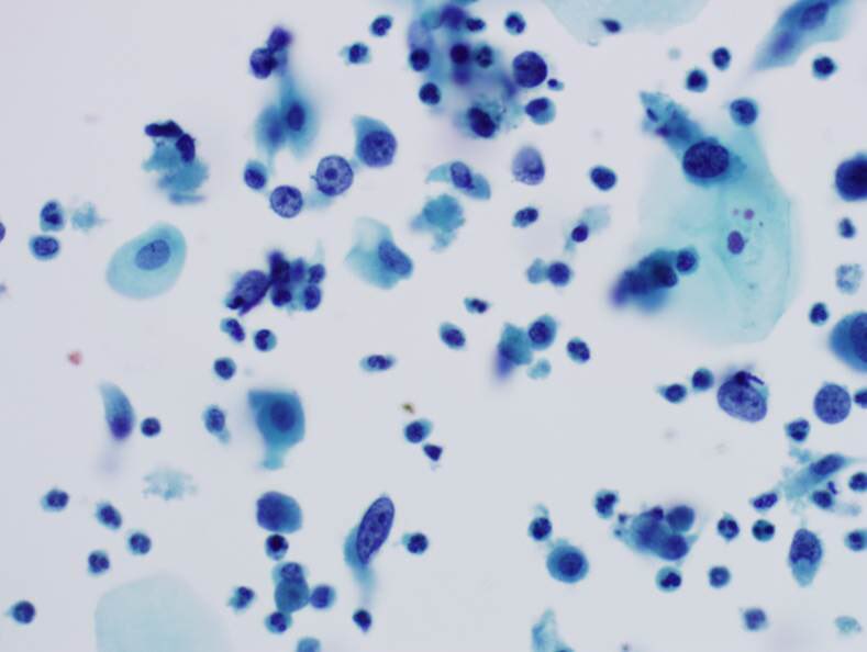 ZMaleki_cyto's tweet photo. Malignant Mixed Mullerian Tumor, Pap test , #SurePath, Cytopathology #89 #CytoPro @barkanga @PathPro @PVielh @doc_kartik @ALBoothMD @cytosantos @britishcytology @IACytology @elena_vigliar @mdlozanoe @tlabiano @PatMcIntireMD @MauroSaieg @tlabiano @NayarRitu https://t.co/7Xkh1jXpJt