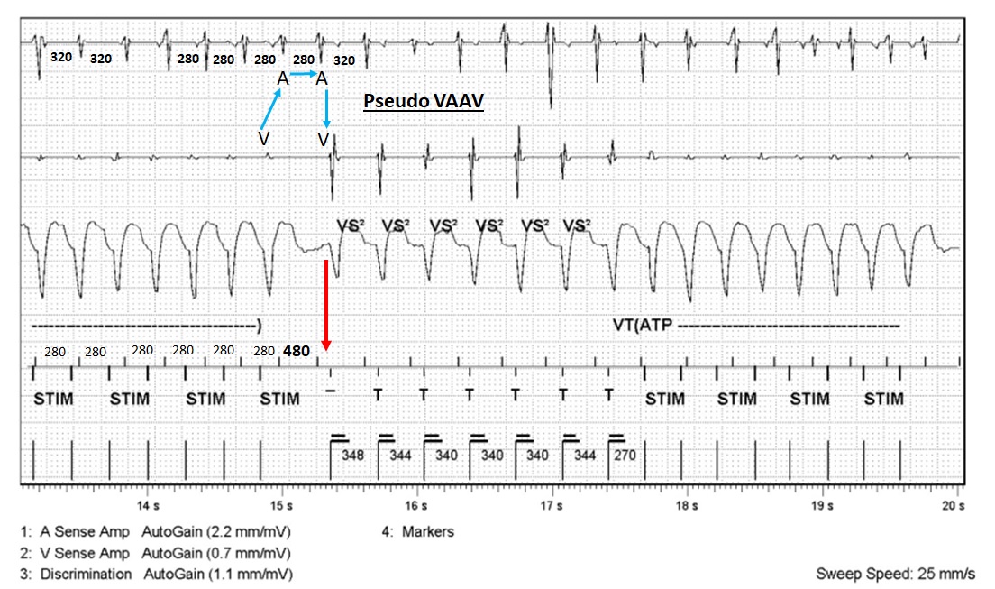kenquadros's tweet photo. Pseudo VAAV response to device ATP with PPI - TCL 140ms and Long SA-VA.
Findings consistent with Atypical Slow-Fast AVNRT.
The value of ICD EGM's and great mentors @True_EP @utedrow @paulzei https://t.co/94ka5KNI6K