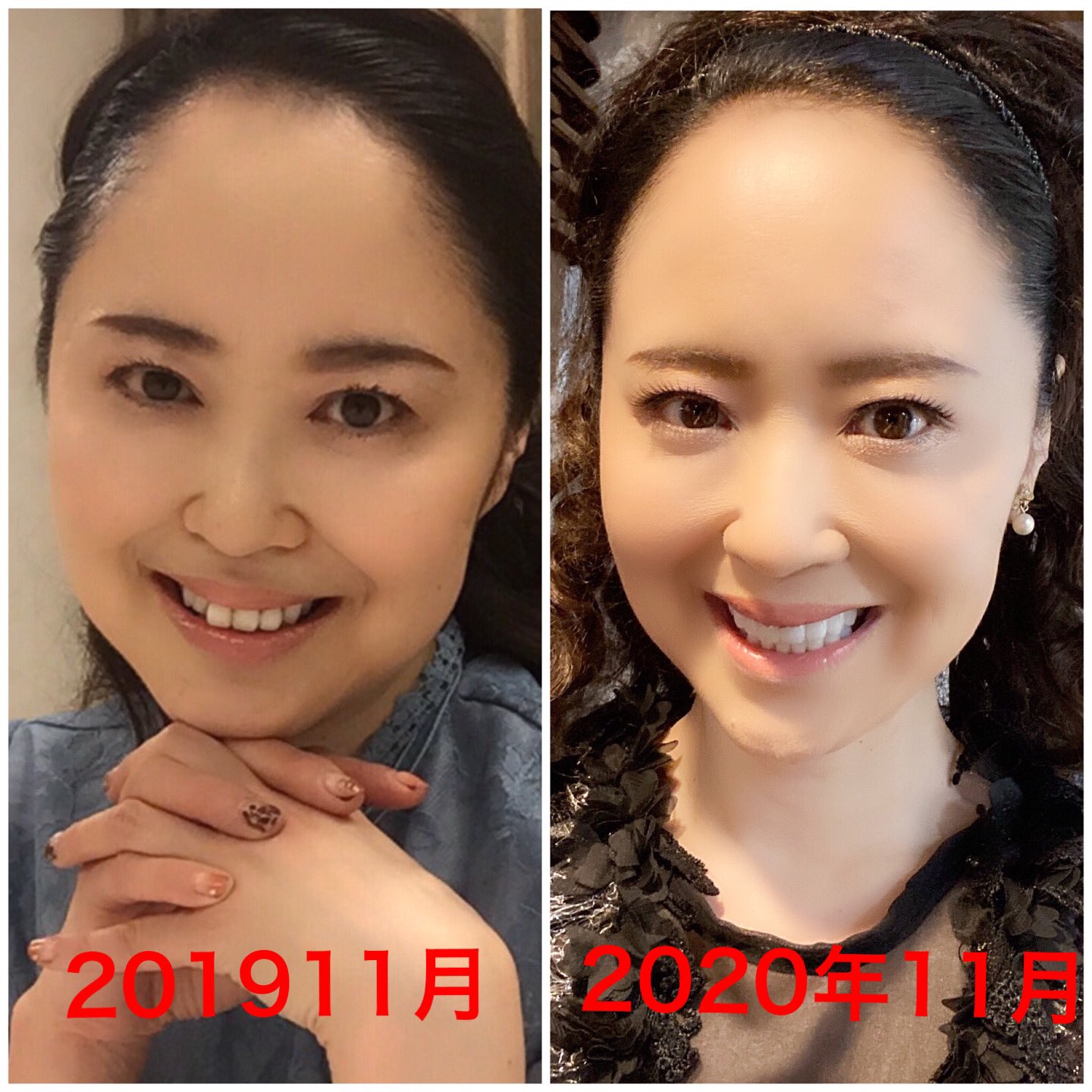 前歯 ブリッジ 芸能人