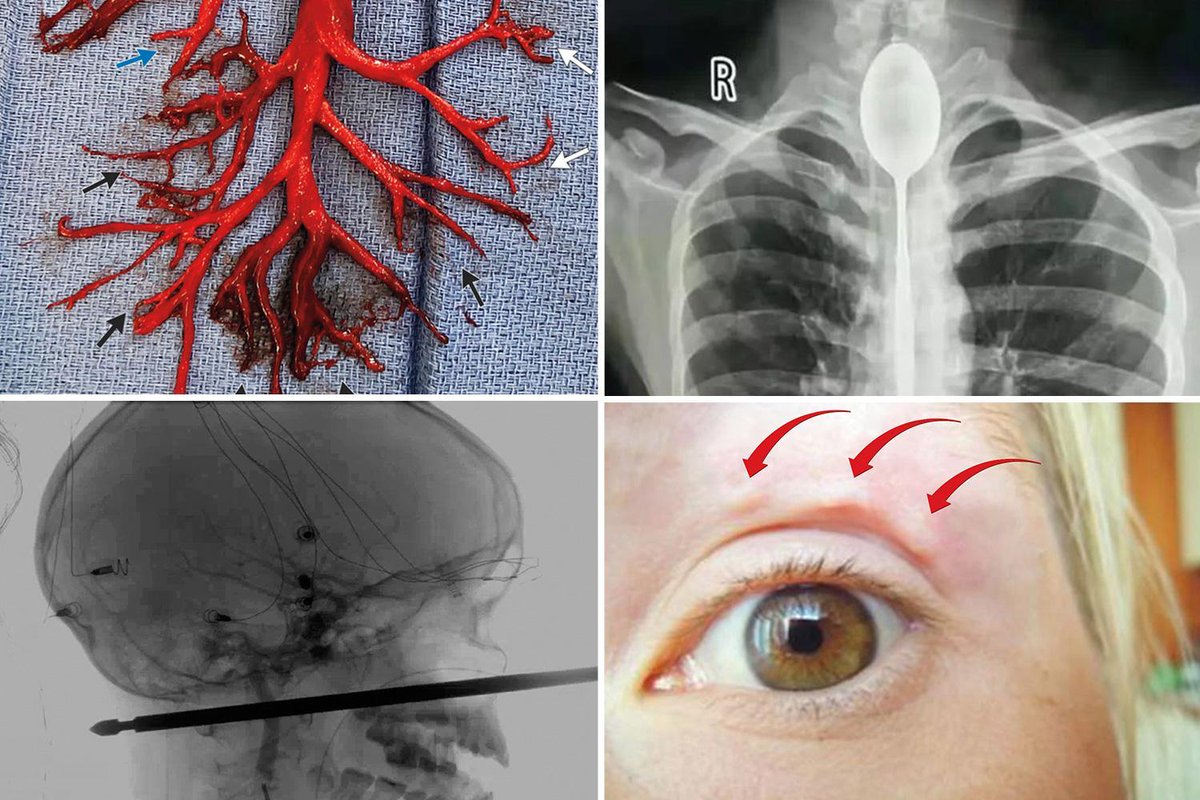 They would find some orifice, usually the nose or ears, and bore pathways into where the current day skull center is now. Before this process, the human corporeal form was largely different in a way that would look grotesque to you now, a form chosen for recreational purposes.