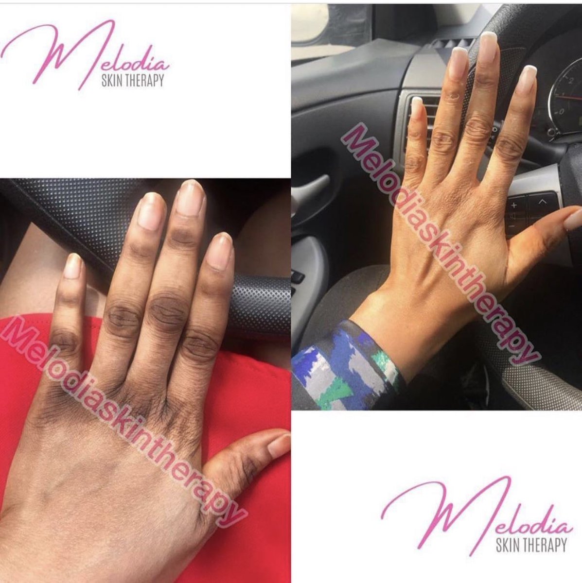 melodiaskin's tweet photo. Be honest with yourself and Look at your  
knuckles are you proud of it??? 😒 
 
How do you feel comfortable knowing your hands are dark 😳  
 
Knuckles can be so annoying and embarrassing  
 Get it clean and clear #ChefForNengi #BBNaija https://t.co/YDUi6ulIyv
