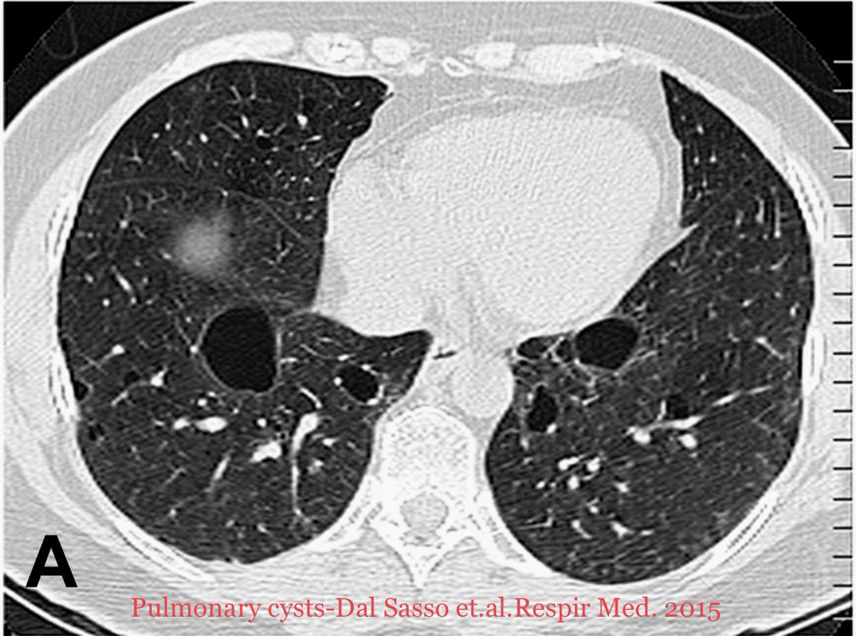 AAlhatem_MD's tweet photo. Birt–Hogg–Dubé Syndrome:

🧚 Autosomal Dominant
🧚 Nonsense/Frameshift Mutations in FLCN (folliculin)/ Ch-17
🧚 mTOR modulation 
🧚 Pulmonary cysts and pneumothorax
🧚 Renal tumors (Chromophobe/ Hybrid Oncocytic..)
🧚 Fibrofolliculomas/ Trichodiscomas #pathresidents #boardexams https://t.co/3EyeQh45vS