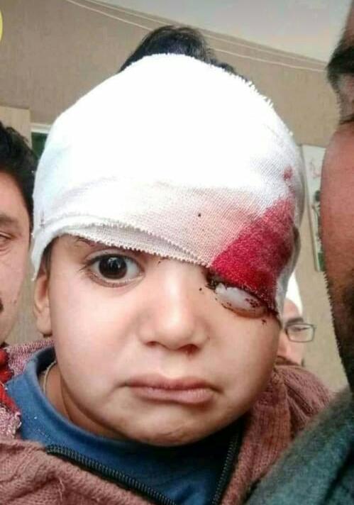 TariqNaqash's tweet photo. This is Abdul Hannan, a victim of Friday's #Indian shelling in #NeelumValley. Many people, incl some officials, claimed last night that he's succumbed. In fact he is alive n being treated in CMH Mzd.The boy who succumbed ystrdsy was Adeeb, 2.
Plz pray for Hannan's early recovery. https://t.co/Oe5Ud2dE2h