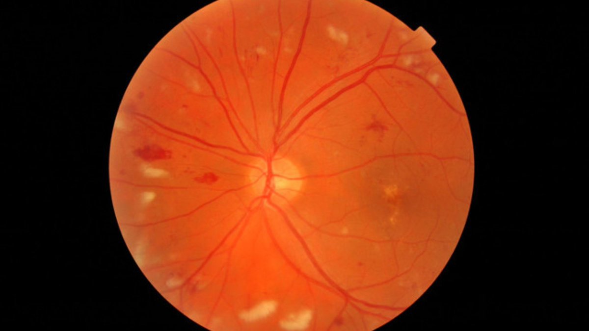 Specsofken's tweet image. Today is World Diabetes day. 

Across the world, 1 in 11 people in 2019 were living with diabetes. If you have diabetes this does not necessarily mean that your sight will be affected, but there is a higher
risk of developing sight problems.

#worlddiabetesday