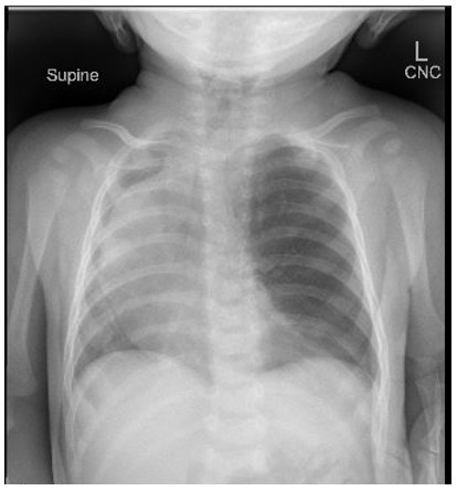 Try to answer this ATS Quick Hits! A former full-term 3-month-old with pectus excavatum presented to her pediatrician with worsening tachypnea and poor weight gain. She was referred to the ED after the chest radiograph shown below was obtained. See more: thoracic.org/professionals/…