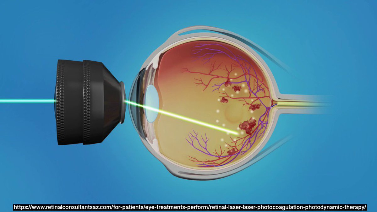 Отслойка сетчатки несвежая. Лазерная коагуляция сетчатки глаза. Отслойка сетчатки лазеркоагуляция. Диабетическая ретинопатия сетчатки глаза что это такое. Лазерная операция на сетчатке глаза.