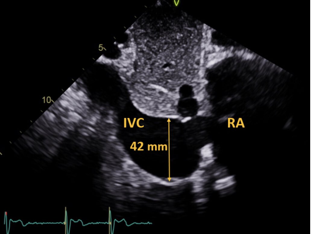 2/6 In certain cases such as this one IVC assumed aneurysmal. IVC aneurysm is defined as 40 mm or greater (reference below) ....  #echofirst