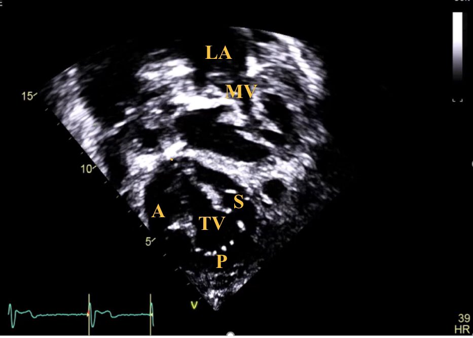 4/6 Same patient, subcostal images can provide an excellent visualization of the tricuspid leaflets morphology (clip attached below)...  #echofirst