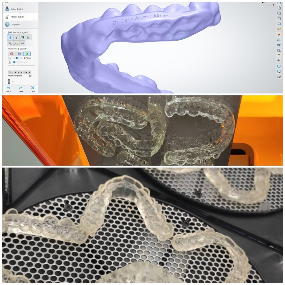 Anterior repositioning splint DijitalOrtodontist lerimizden Dr Cenk Akcan  beyden yeni bir splint tasarımı öğrenerek repertuarımıza katmış olduk.😎 Resmi olan çoğu tasarımı beraberce yapabiliriz diye düşünüyoruz 🤓☺️ #anteriorrepositioningsplint
#DijitalTMJSplint #3dsplint