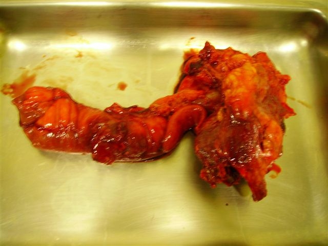 CelestinoGutirr's tweet photo. My worst appendicitis was this: an appendicular plastron with cecal necrosis
Intervention: Resection ileocolic droite (whit resection of part of the right colon)
These images had already been posted before https://t.co/7KqnoQy9x3