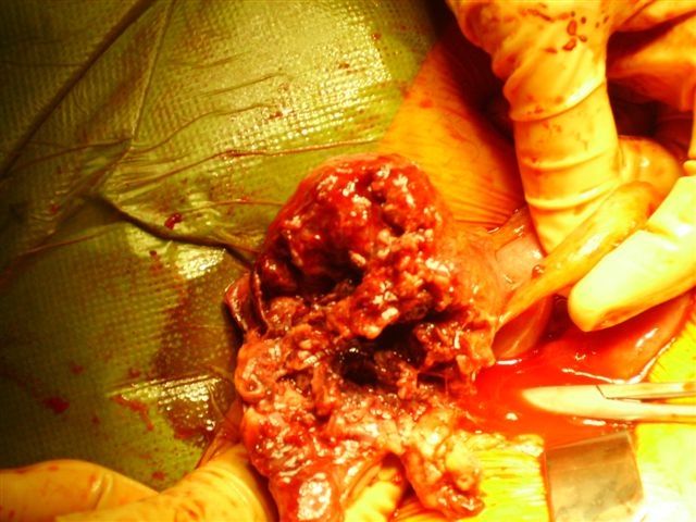 CelestinoGutirr's tweet photo. My worst appendicitis was this: an appendicular plastron with cecal necrosis
Intervention: Resection ileocolic droite (whit resection of part of the right colon)
These images had already been posted before https://t.co/7KqnoQy9x3