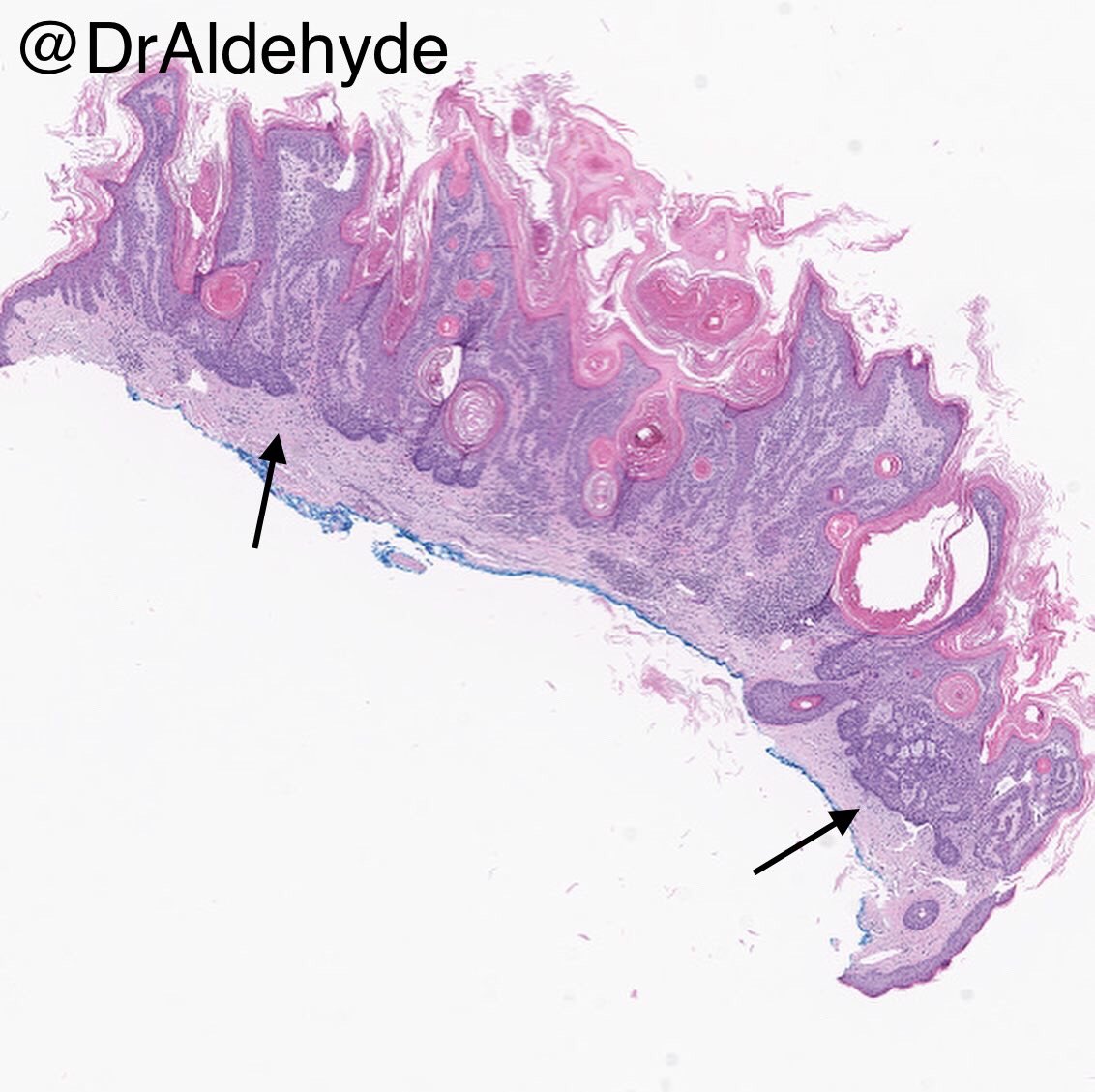 Seborrheic Keratosis Histology