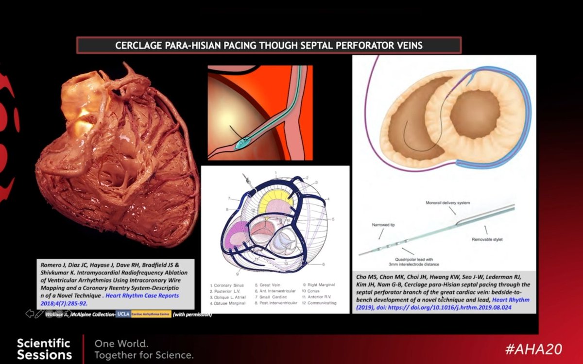 rhythmkris's tweet photo. #cerclage #physiologicpacing #AHA20 https://t.co/luYGKBkCTu