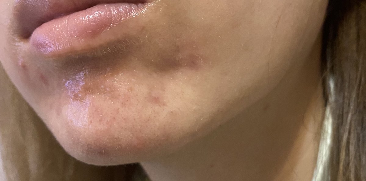 汚肌日記 みぃ Nikibi 0314 Twitter