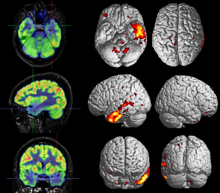 SEMNIMoficial's tweet photo. El #GTNeuroimagenSEMNIM publica en su blog el artículo de formación continuada en la REMNIM: Relevancia de la cuantificación en estudios PET cerebrales con 18F-FDG. Puedes consultarlo en https://t.co/Q7092qaeMO https://t.co/A9exgg3Imq