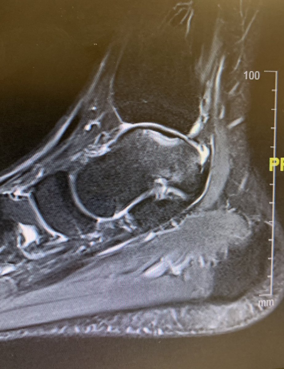 🟢OSTEOCONDRITIS DE ASTRÁGALO🟢
♦️Es una lesión del cartílago del tobillo. Puede ser asintomática.
🔺Tratamiento inicial conservador: RHB, plantillas e infiltraciones.
🔻Cirugia artroscopia con técnicas de estimulación (perforaciones) o reparadoras (MACI)