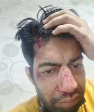 DeeptiDeepu13's tweet photo. Vibhor Anand attacked by mysterious people. Vibhor has shared this picture..
Is there any law exist in India?? If yes..then Why all this happening?
#Modiji do something 🙏🙏
#Shame on Udhav Govt
 @saketjaiswal_sj @PMOIndia @HMOIndia @narendramodi 
#CBINameSSRKillers https://t.co/TSbIQuphx4