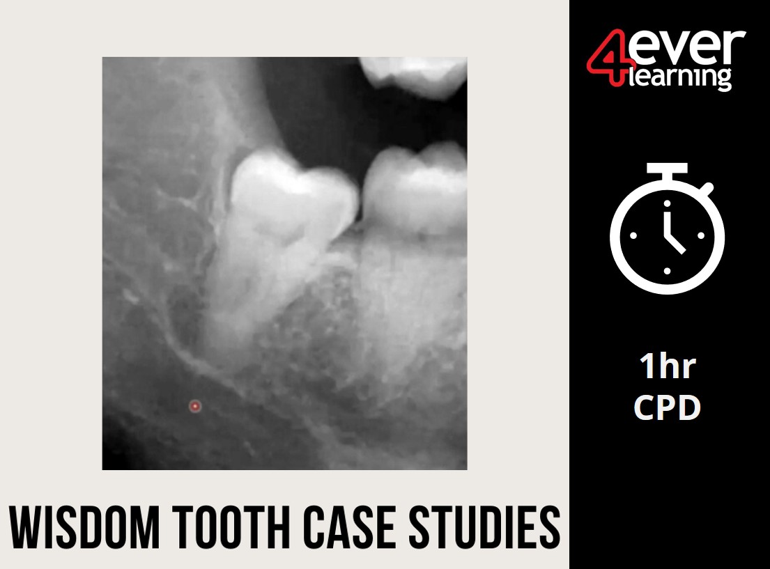 Another NEW video course just published for our members!
This week’s #CPD core subject covers wisdom tooth extractions. 🦷🦷🦷
A comprehensive course to help you assess and manage situations in the practice.
Not yet a member? Join today at 4everlearning.com! 
 #dentistry