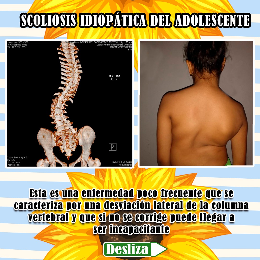 <a href="/El_Noticiero/">El Noticiero Televen</a> buenos días, señores por favor necesito me ayuden, mi hija padece de ESCOLIOSIS IDIOPATICA, requiere una intervención quirúrgica para ser operada con urgencia de la columna, no contamos con los recursos para comprar la prótesis, Dios les Bendiga 🙏