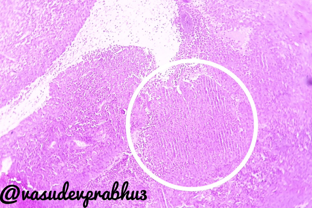 #histotechniques #Microtomy
(Synovial biopsy) What is the problem with the circled area? 
What is the cause and how to rectify it? #pathboards #examquestion #practicalhistopathology