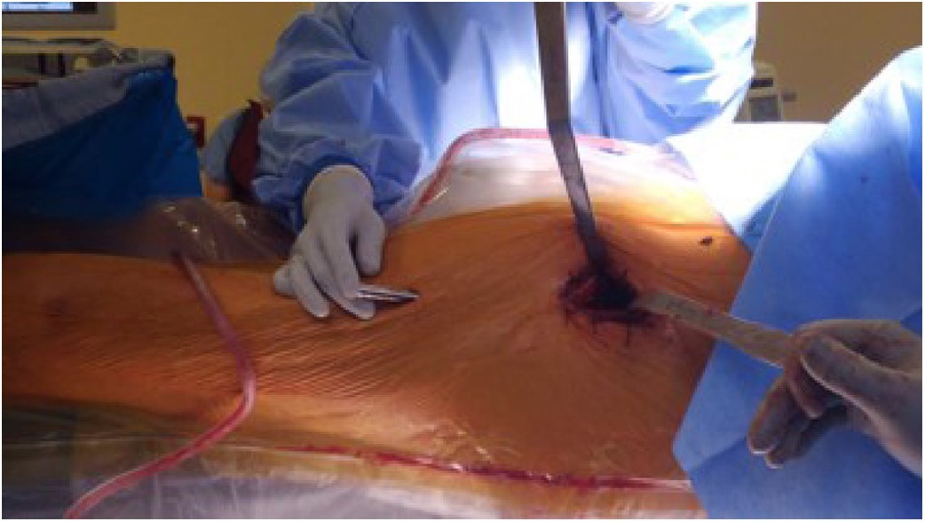 ArthroToday's tweet photo. #OrthoTwitter, as the minimally invasive posterior #THA approach debate continues...Check out this article: Anterior Percutaneous-Assisted Total Hip Arthroplasty (PATH): Surgical Technique and Early Outcomes. @DrLeeRubin @drsebheaven @CenterRotation
https://t.co/nEDtwivJlD https://t.co/YuQehjReIt